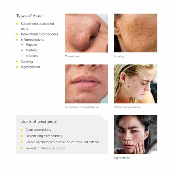 Benoxor Clear Acne Cream 30ml - Image 4